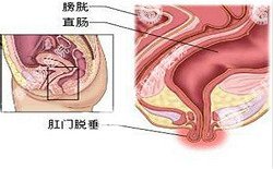 南寧治療脫肛哪家醫(yī)院好？南寧脫肛治療多少錢？